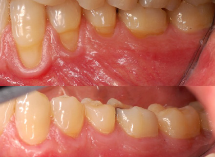 cirugia-periodontal-440