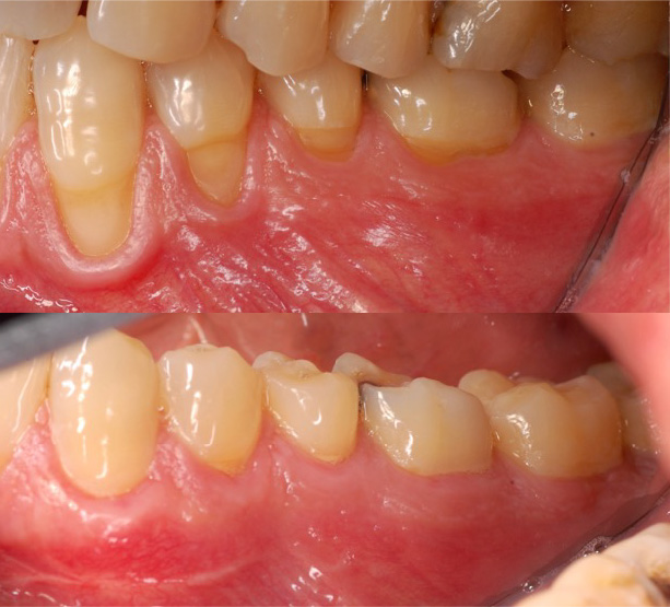 cirugia-periodontal