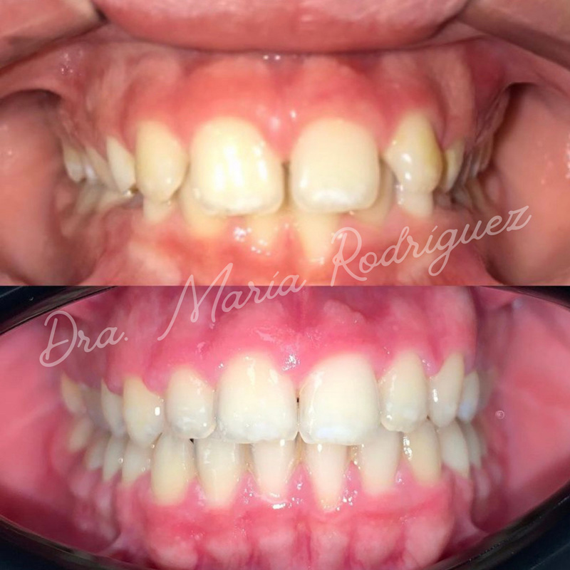 nino-15-ortodoncia-fija